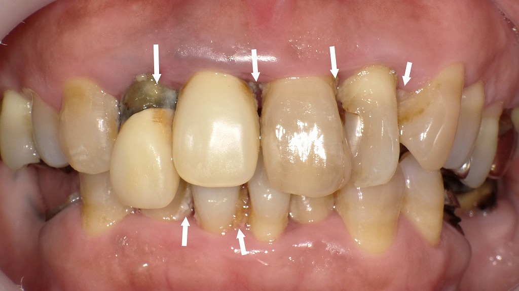前歯に大量の歯石と汚れが付着し、古い差し歯の不適合や変色が目立つ状態。歯周病による炎症と歯の動揺も確認される。