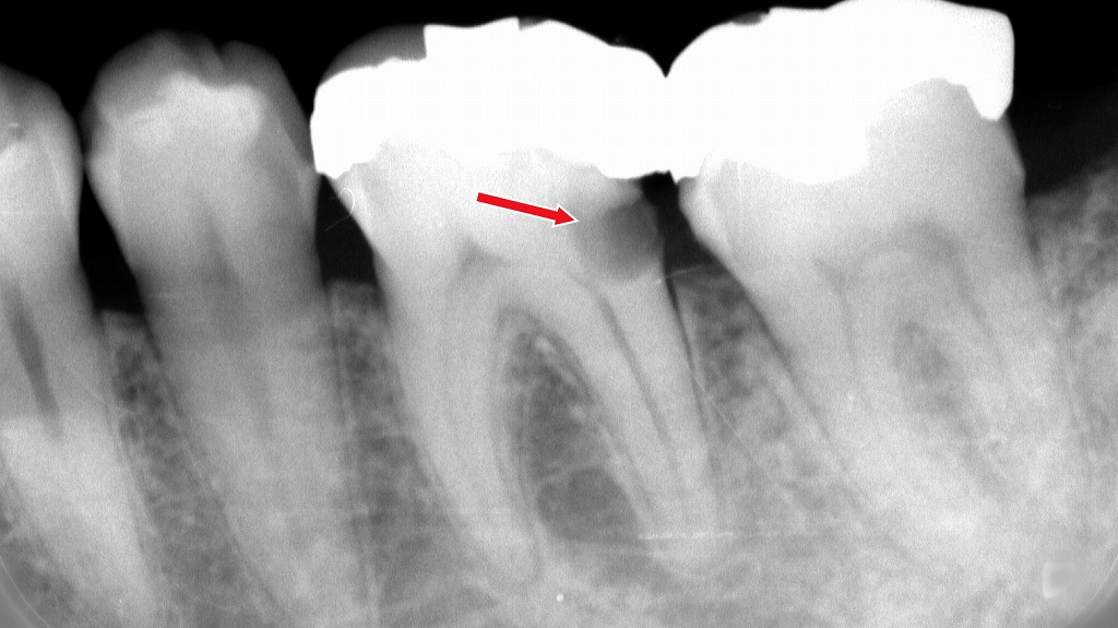 噛むと痛い原因は？奥歯の“見えない虫歯”が神経まで進行