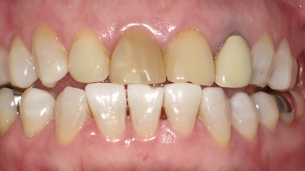 外傷や神経の失活によって前歯が黄褐色に変色した状態です。