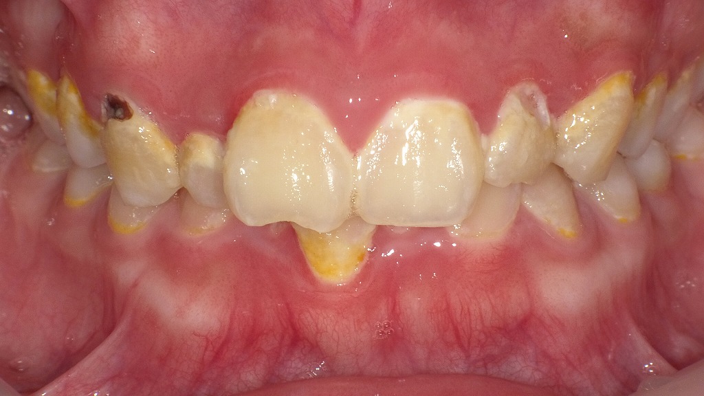 虫歯とプラークの関係
