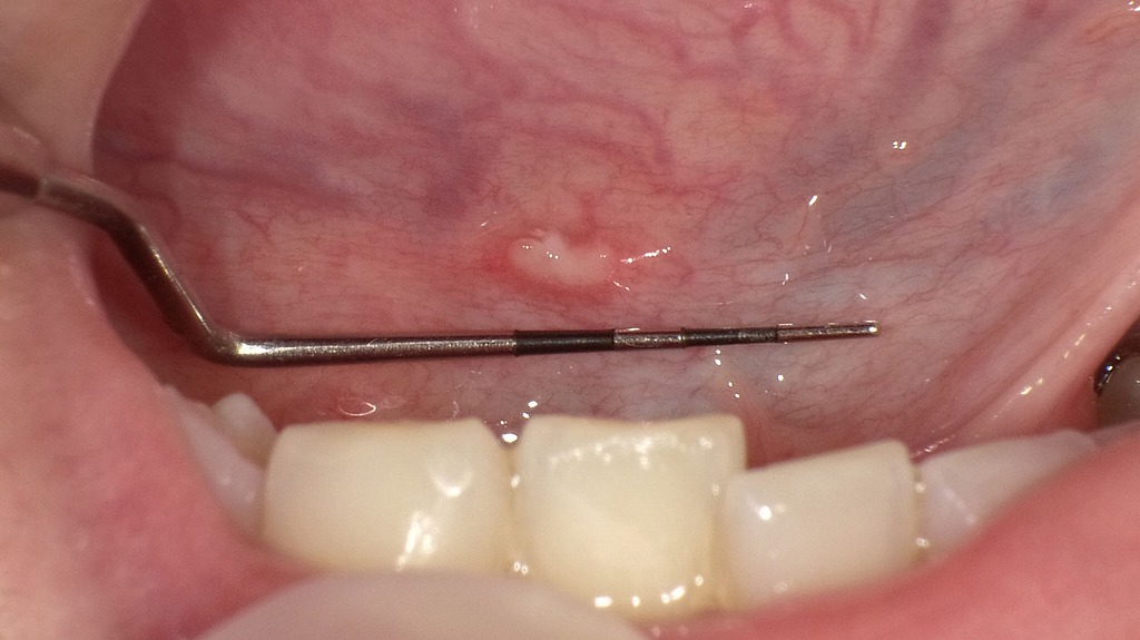 舌の裏にできたアフタ性口内炎