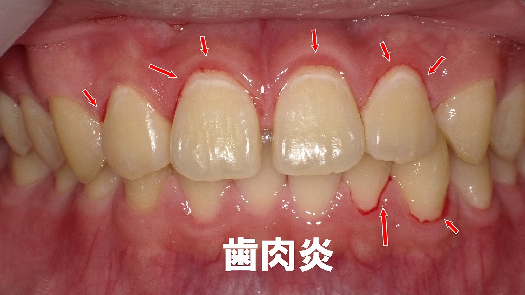 歯と歯ぐきの境目にたまったプラークが、赤い腫れと出血を引き起こしています。