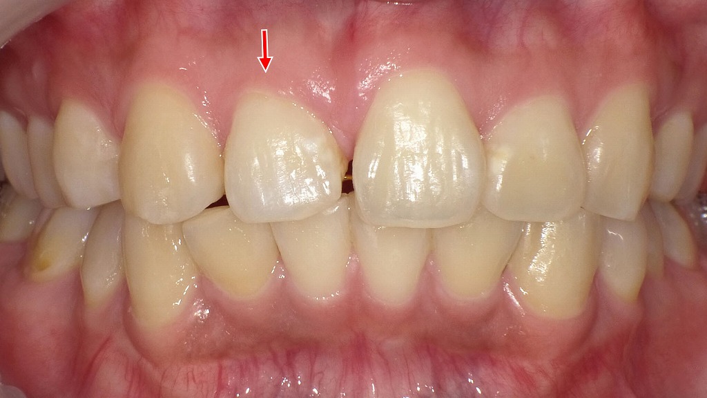 右上顎1番が短く小さいことによる前歯のすき間