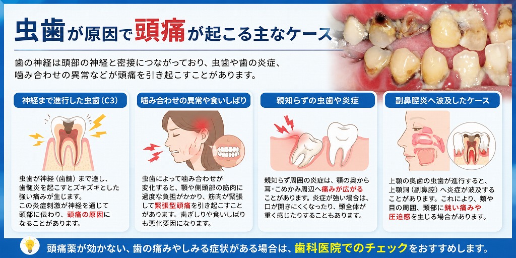 虫歯が原因で頭痛が起こる主なケース