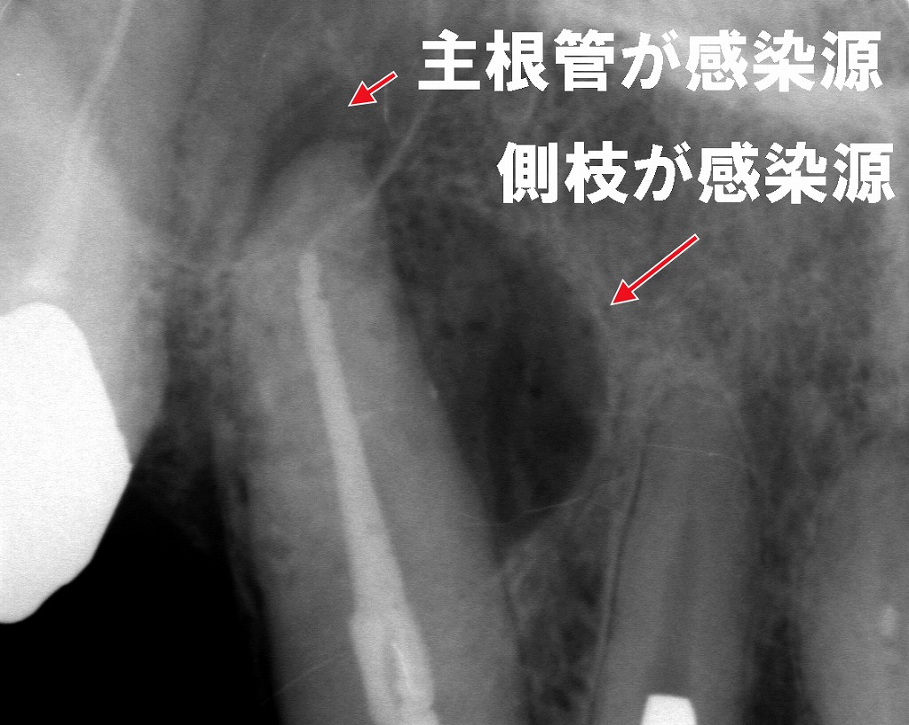なぜ根管治療が終わらない？ ― 見逃されやすい“側枝感染”の存在