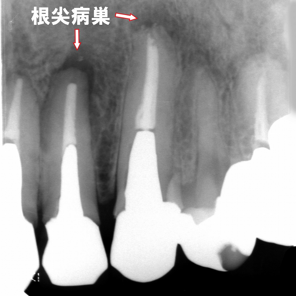 根管治療が失敗した症例