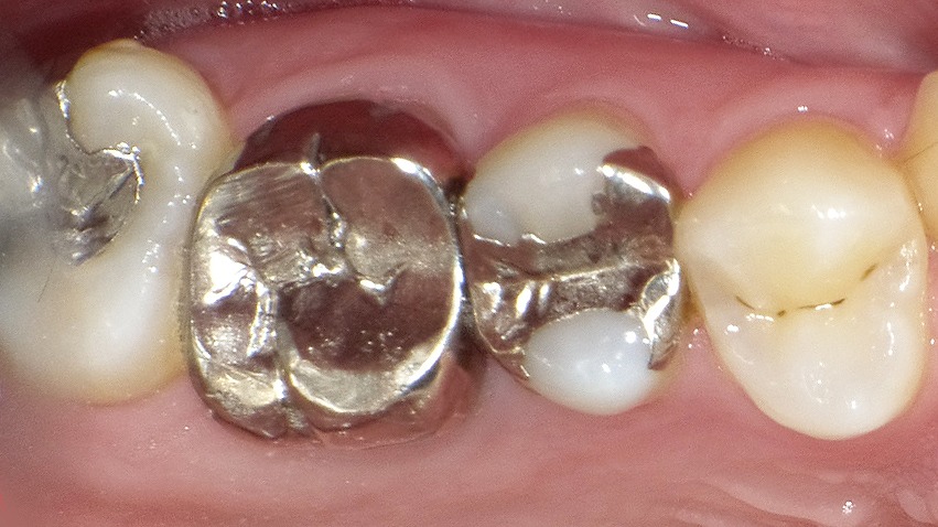 銀歯が原因？知らないうちに進む金属アレルギーのリスク