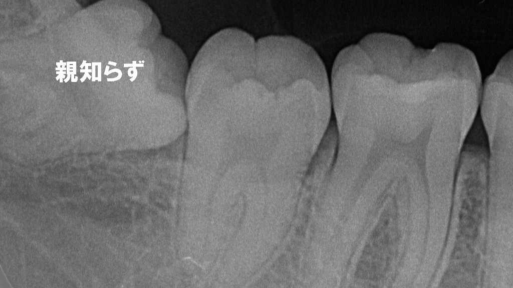 歯がむずむず…その違和感、親知らずが押しているサインかも