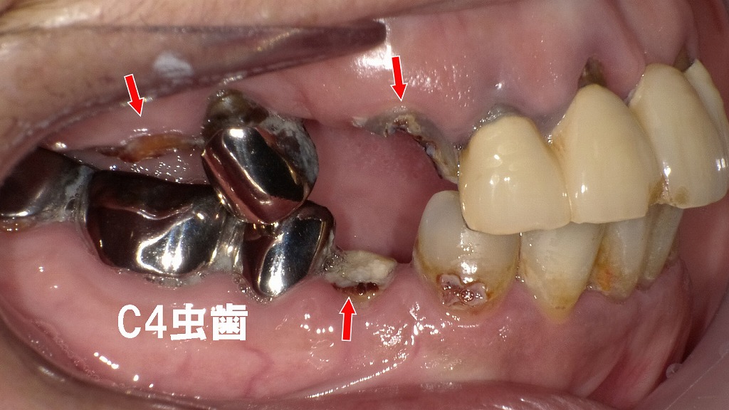 歯の残存本数が健康寿命を左右する:右側咬合の崩壊が示すリスク