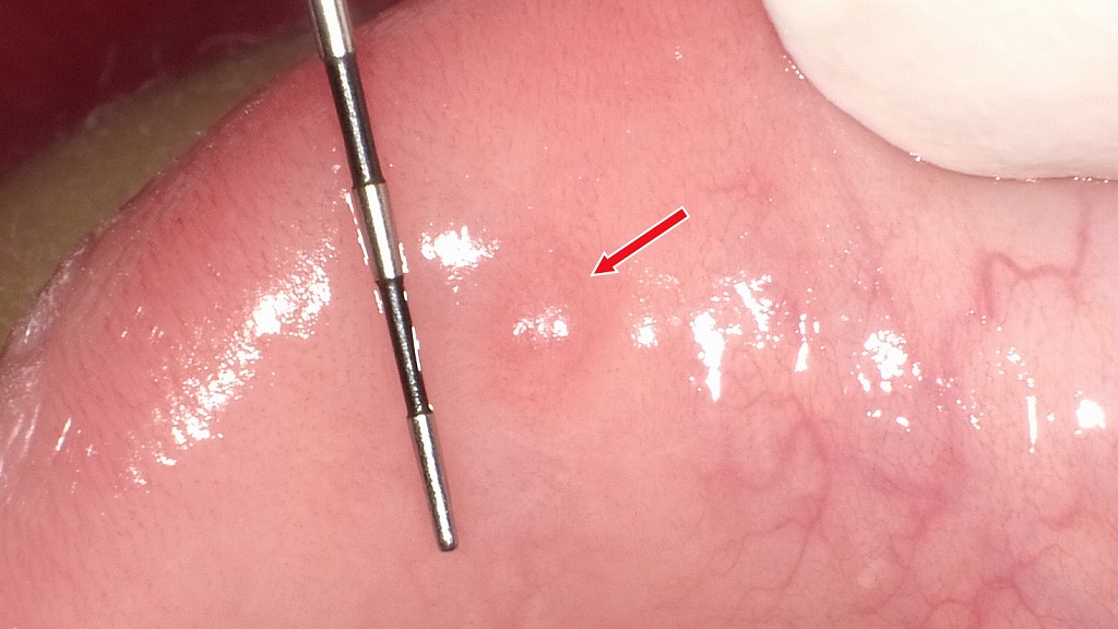 下唇に出来た粘液嚢胞