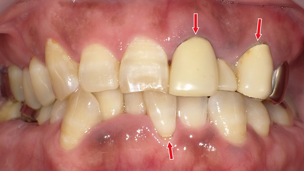 術前：歯ぐきの腫れと出血リスクが高い状態