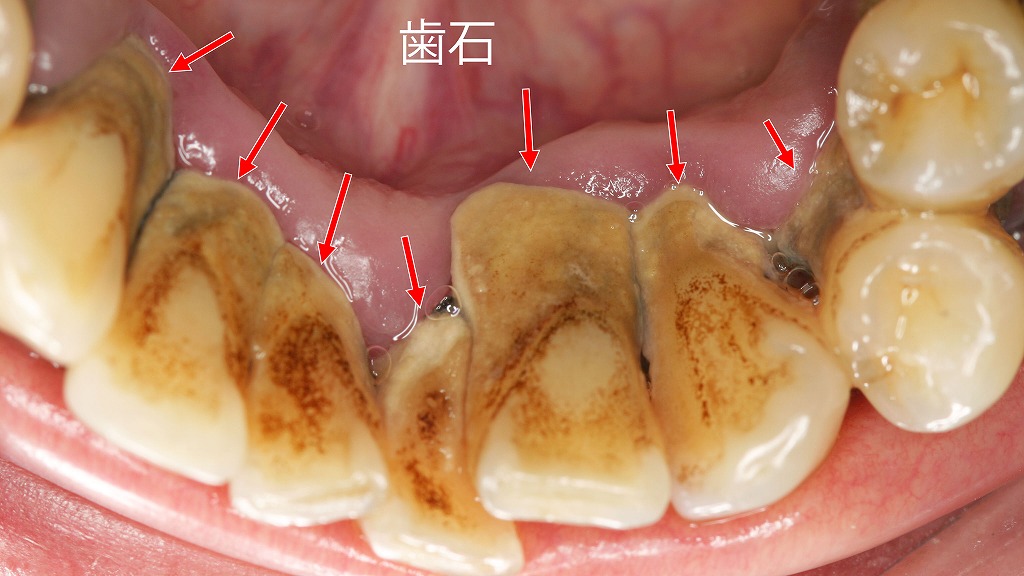 歯ぐきの内側に溜まった歯石