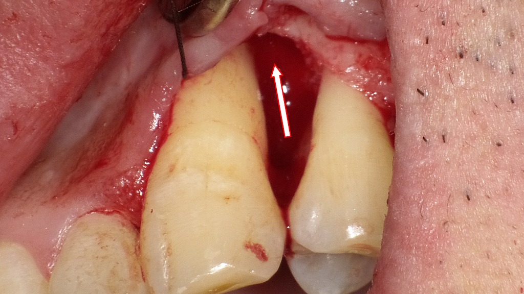 フラップ手術(歯肉剥離掻爬術)