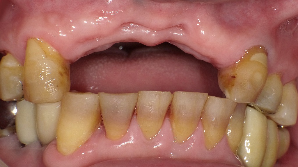 保存不能となった上顎前歯を抜歯した直後の状態。