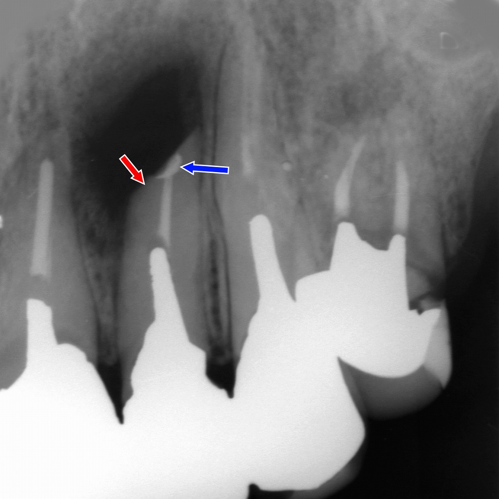 歯根端切除術・逆根充・歯根嚢胞摘出術