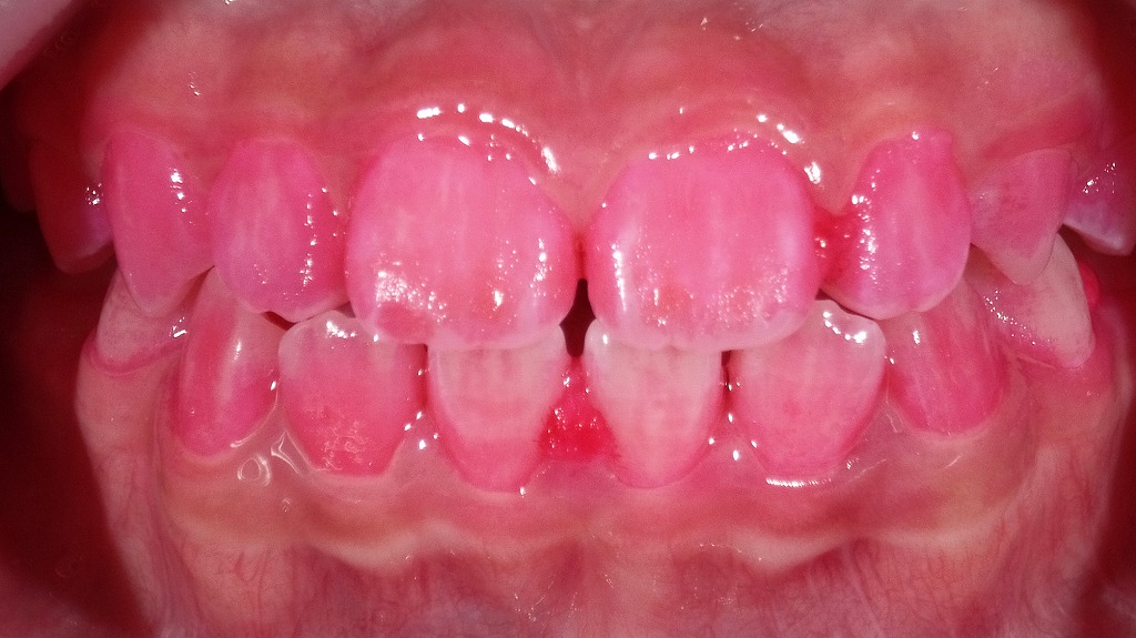 歯磨き前のプラークチェック：磨き残しを“見える化”