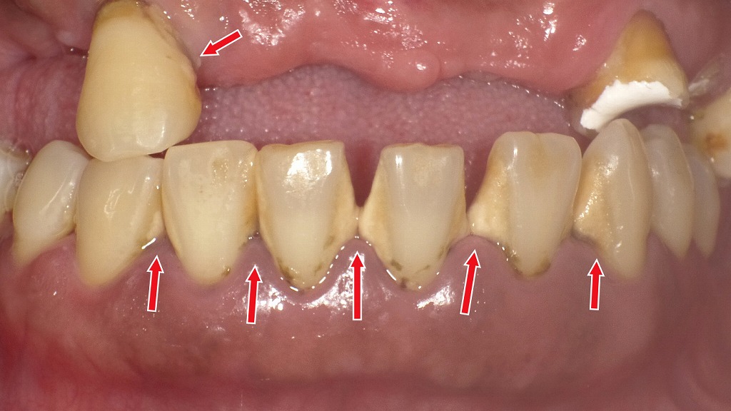 噛むと歯が痛い原因は“歯石と歯ぐきの炎症”
放置した歯石が噛み合わせ痛の引き金に
