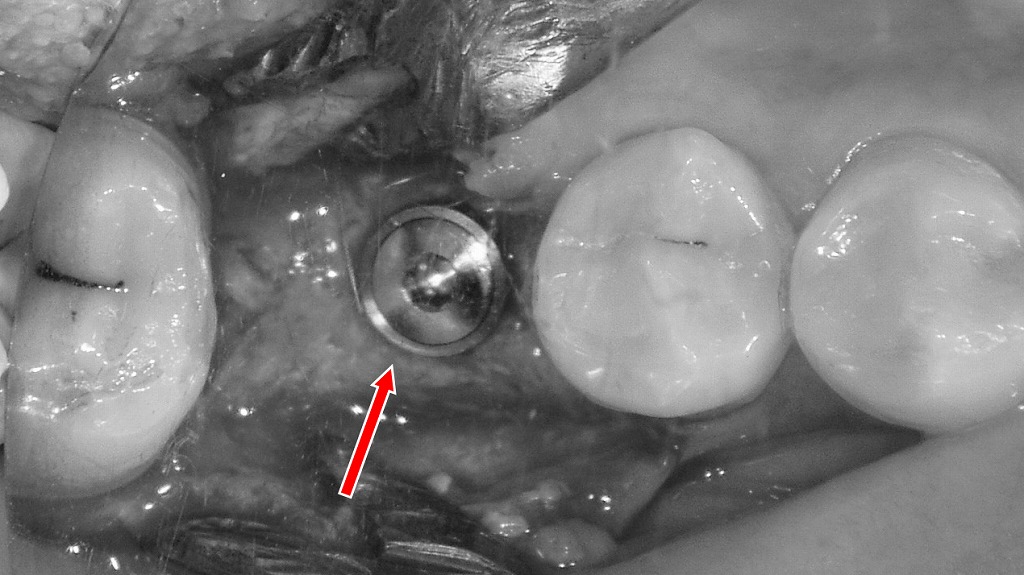 下顎6番欠損へのインプラント埋入手術:一本義歯との比較検討