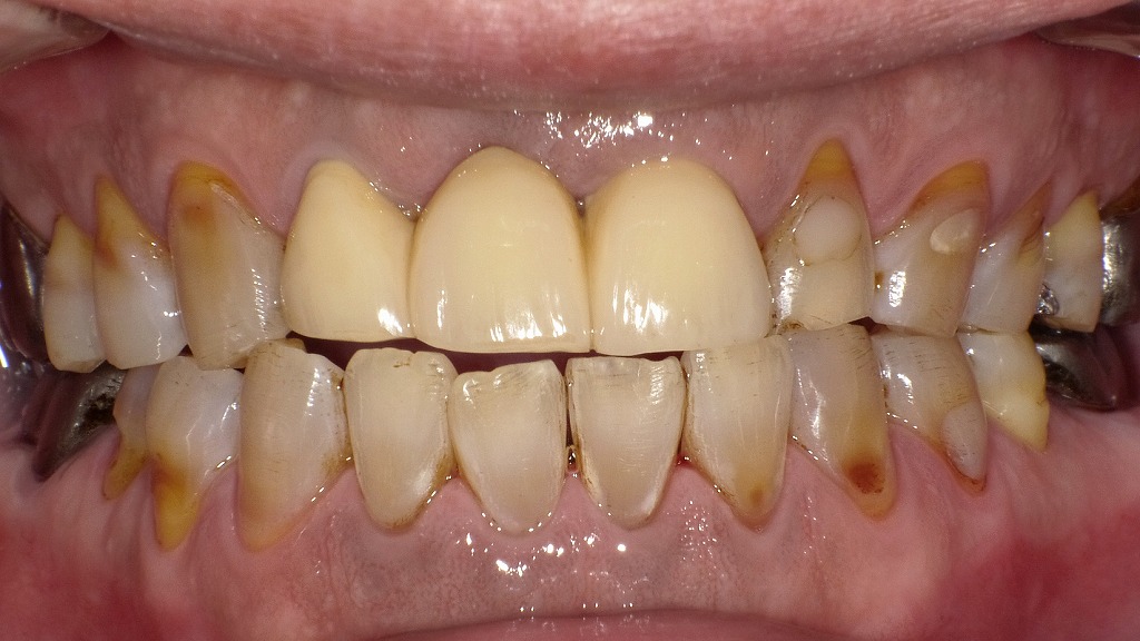 術後:強い着色(ステイン)除去