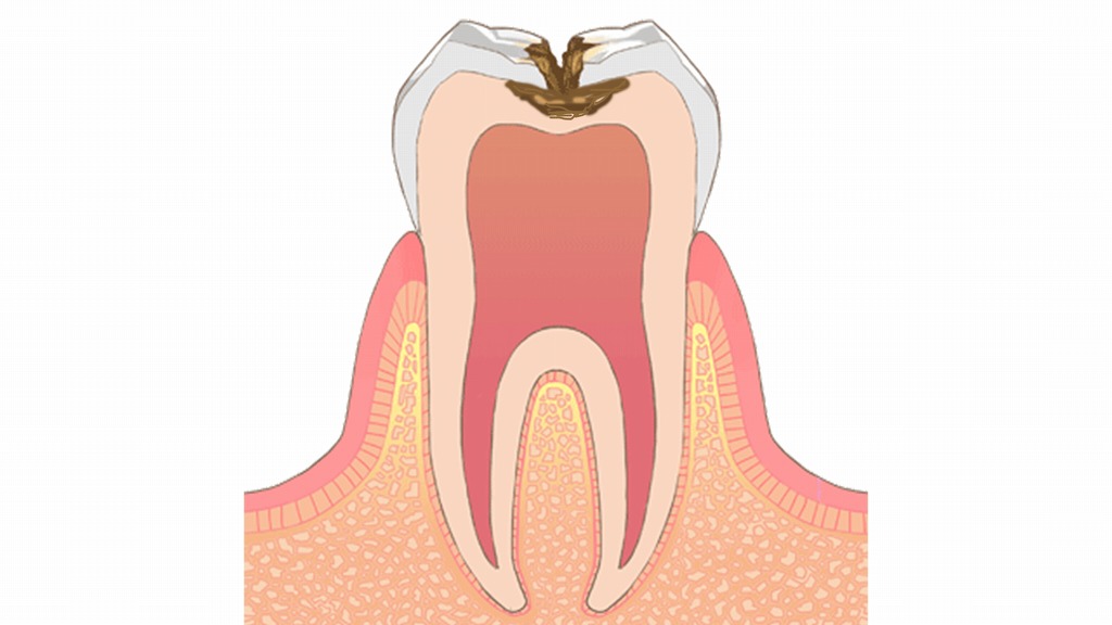 見た目は小さいのに中で大きく進行する虫歯