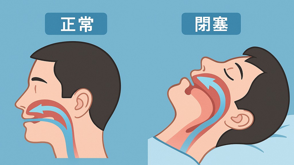 睡眠時無呼吸症候群とは？