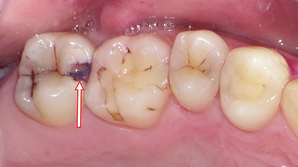 口臭の原因となる虫歯の症例