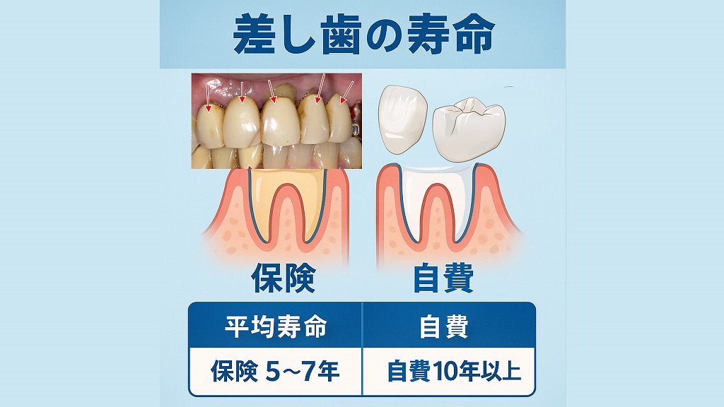 差し歯の平均寿命