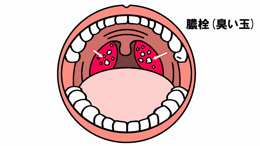 臭玉（膿栓）