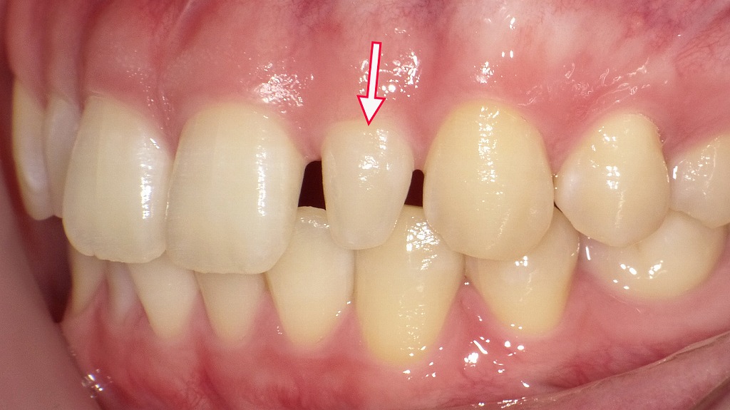 左上顎側切歯が矮小歯