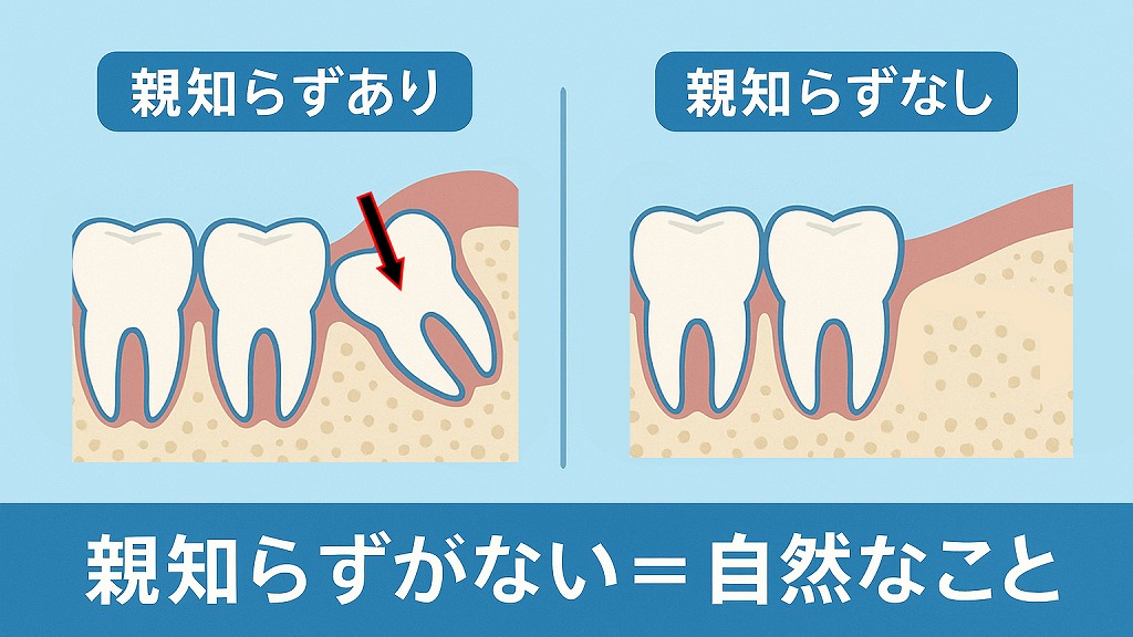 親知らずがない人はどれくらいいるのか