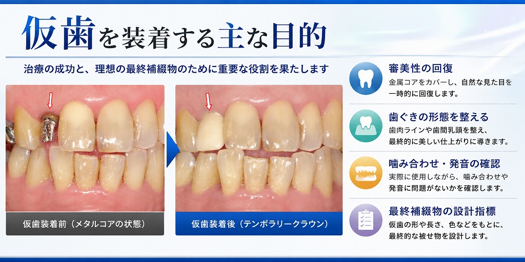 仮歯を装着する主な目的