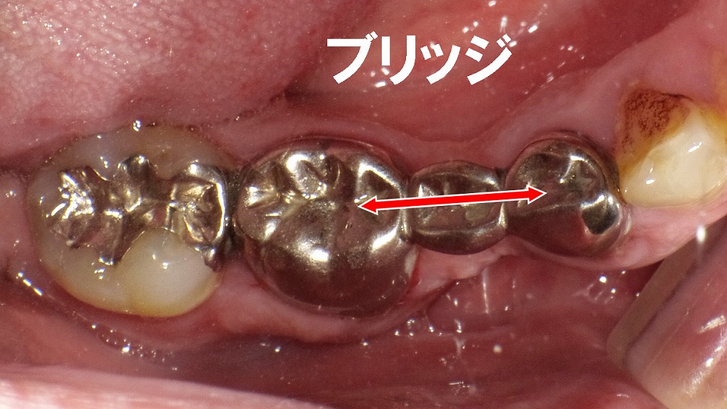 下顎5番欠損の保険ブリッジ