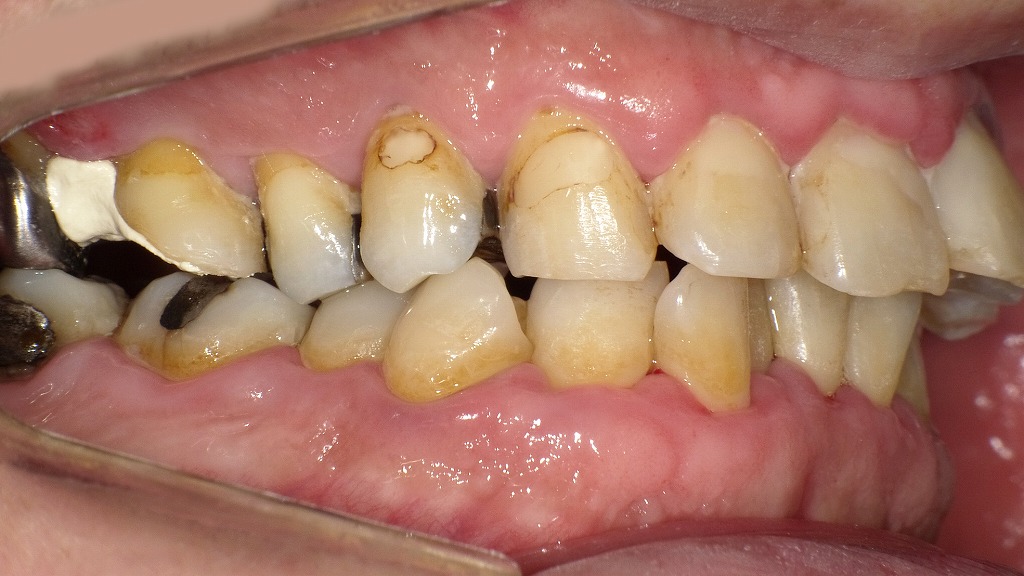 中等度歯周病：右側面