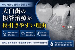 大臼歯の根管治療が長引きやすい理由