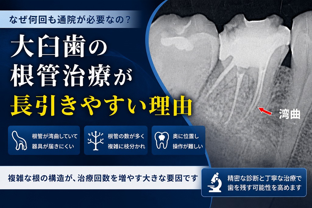 根管治療が終わらないのはなぜ？長引く理由・治療回数の目安を解説