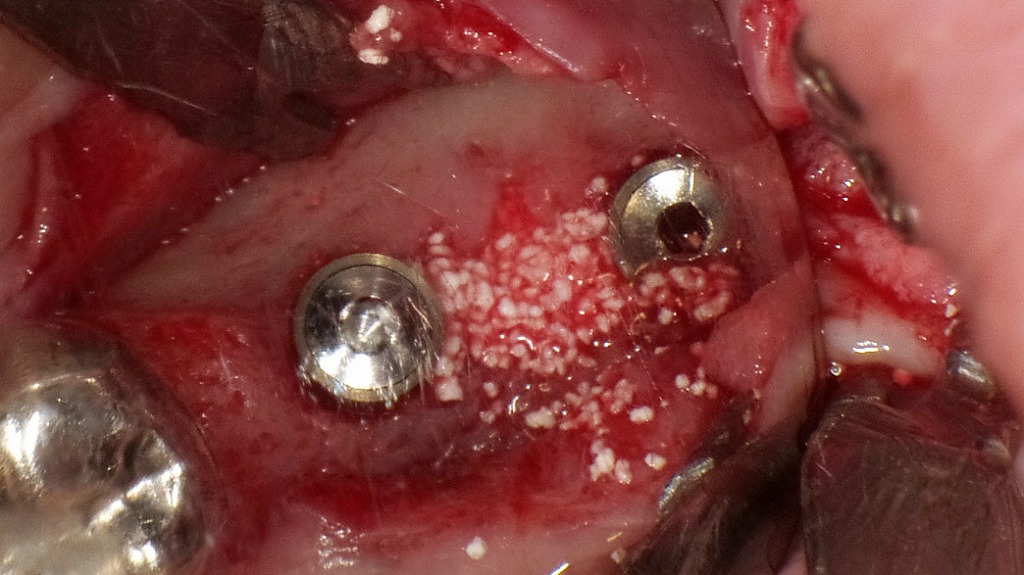 1枚目：インプラントの埋入手術