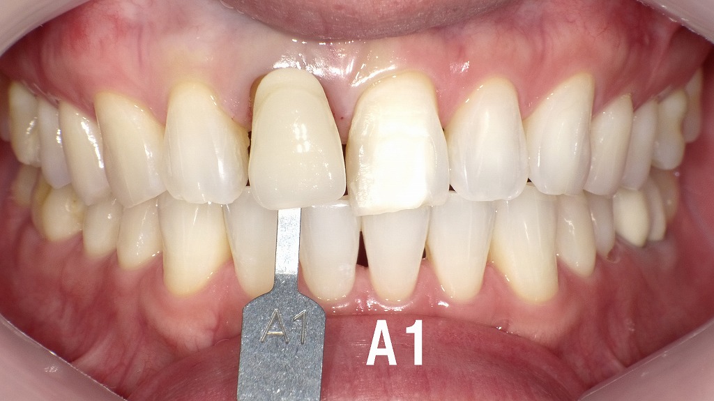 シェードテイキング