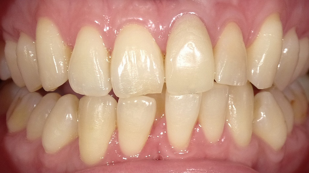 2枚目：ホワイトニング後