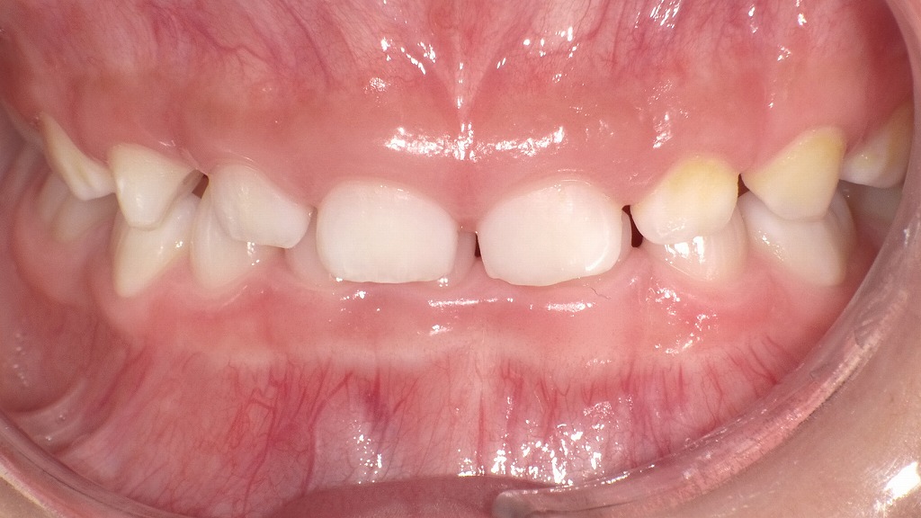 症例１：子ども（乳歯）の過蓋咬合