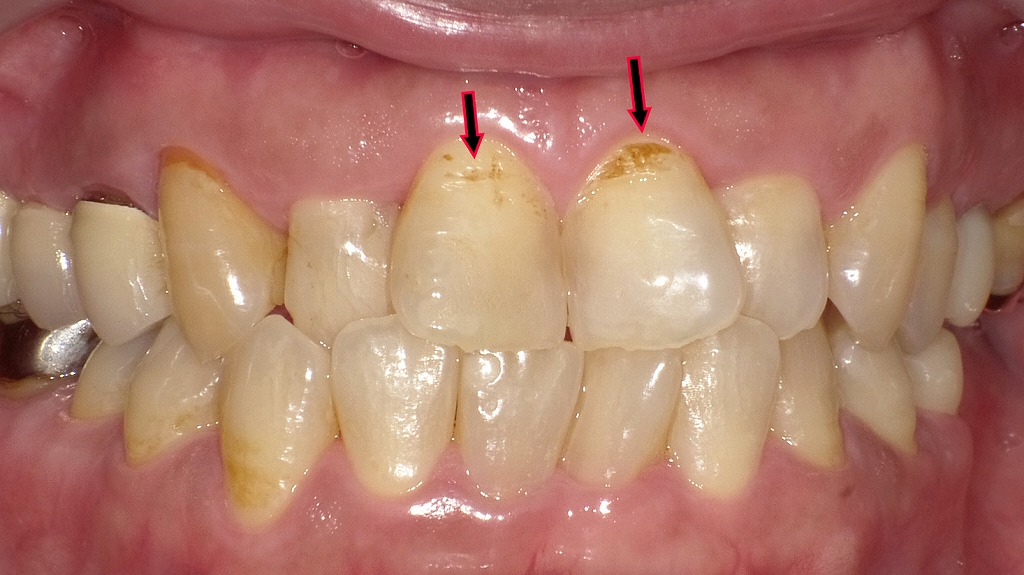 前歯の虫歯の症例１