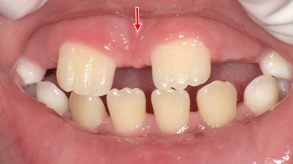 正中離開がみられる永久歯の萌出途中の口腔内所見