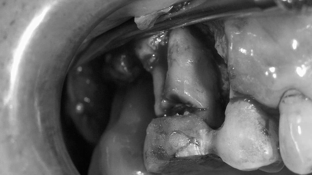 フラップ手術(FOP)後、歯根面の徹底したデブライドメントにより感染組織が除去され、歯肉内部が清潔になった状態。炎症源が取り除かれ、治癒を促す環境が整った。
