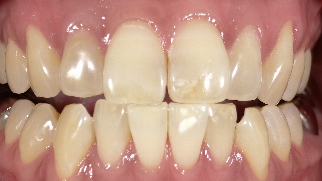 2枚目：ホワイトニング後