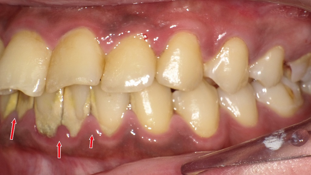 歯ブラシの硬さ選び：強く磨けば良いわけではありません