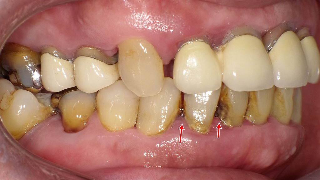 歯石の蓄積による歯茎退縮