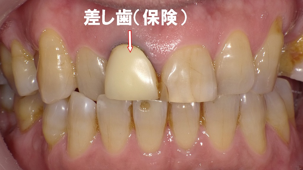 差し歯（保険適用の硬質レジン前装冠）