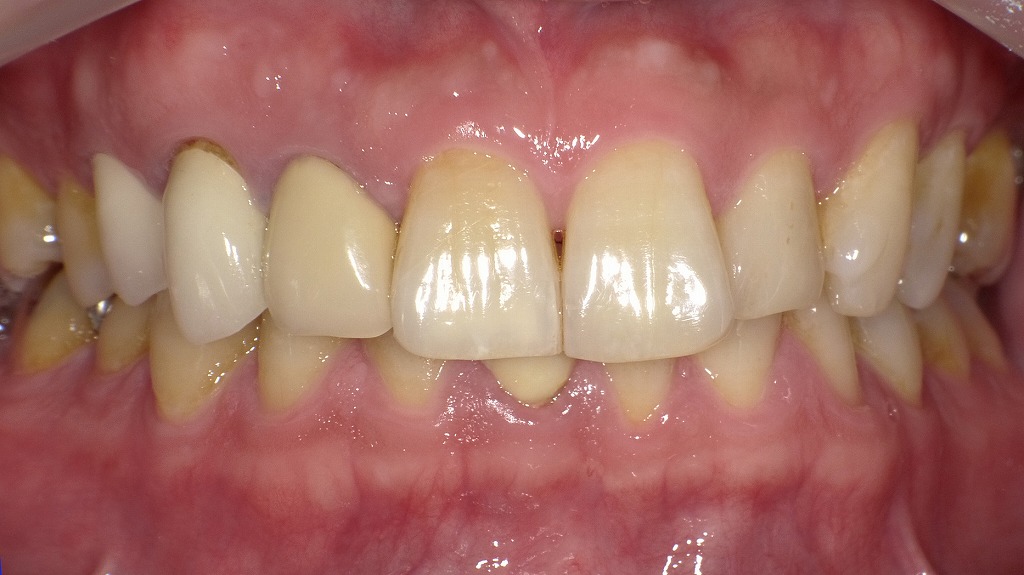 Before：歯全体が黄ばみ、人工歯との色の差は目立ちにくい状態