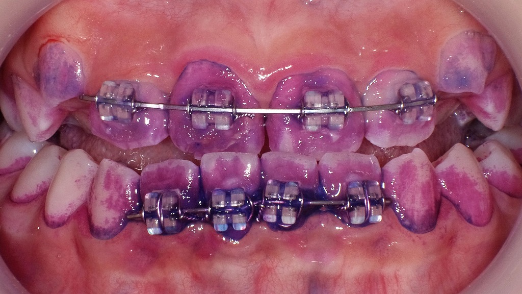 矯正治療中の歯磨き