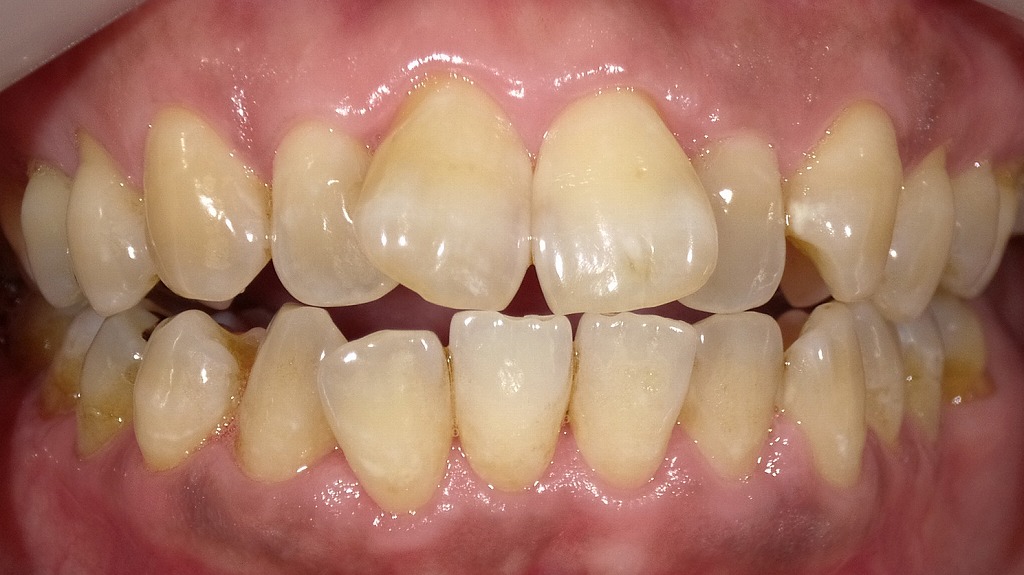 1枚目：ホワイトニング前