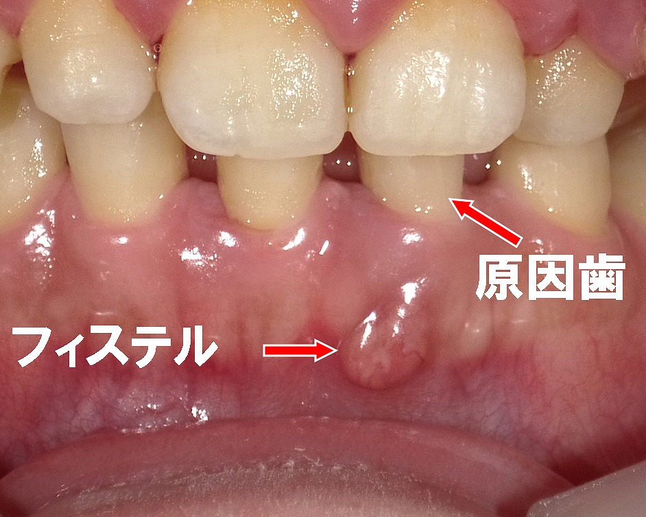 フィステル(瘻孔)は、歯の根の炎症でできる膿の出口。
虫歯がない左下1番の内部で感染が起きています。